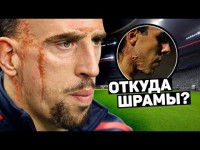 ЖУТКИЕ ШРАМЫ ФУТБОЛИСТОВ. Шокирующие истории шрамов Рибери, Тевеса и др. Футбольный топ